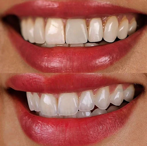 Teeth Whitening image